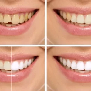 Bonding treatment, smile-make-over, thenorthmiandental.com