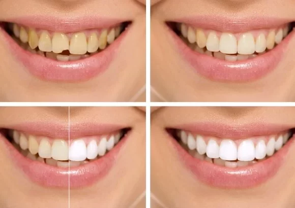 Bonding treatment, smile-make-over, thenorthmiandental.com