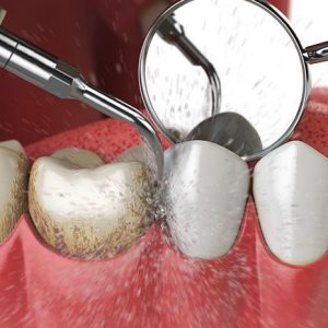 Dental Hygiene being done, thenorthmaindental.com