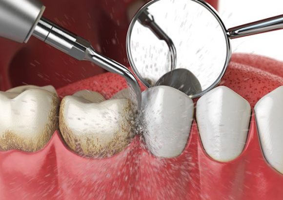Dental Hygiene being done, thenorthmaindental.com