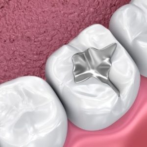 Dental fillings, thenorthmaindental.com