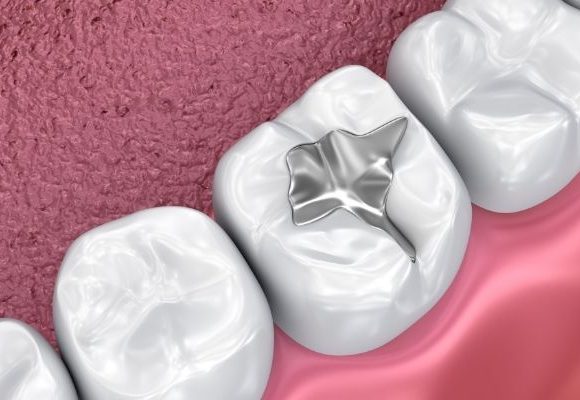 Dental fillings, thenorthmaindental.com