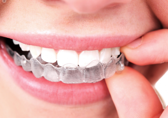 Invisalign Treatment at thenorthmaindental.com