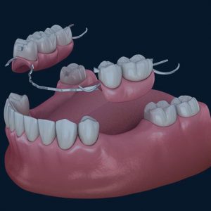 Missing-teeth- bridges treatment, thenorthmaindental.com