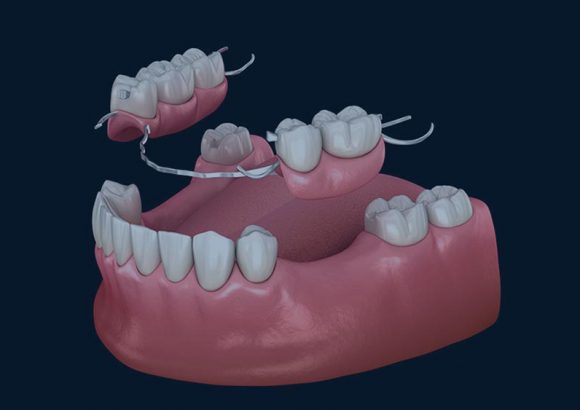 Missing-teeth- bridges treatment, thenorthmaindental.com