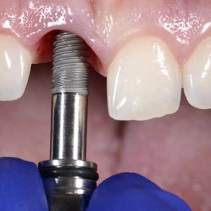 Dental Implant Installation, thenorthmaindental.com