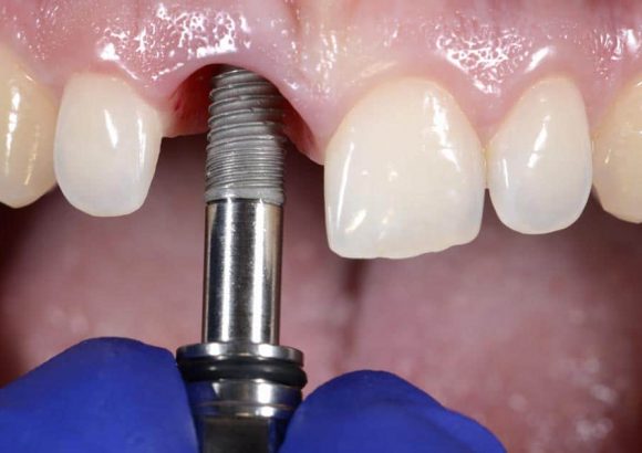 Dental Implant Installation, thenorthmaindental.com