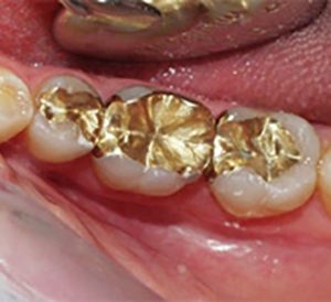 Dental gold-inlays, thenorthmaindental.com