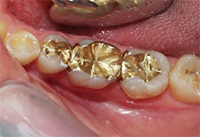 Dental gold-inlays, thenorthmaindental.com