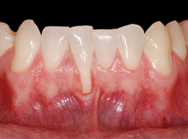 Periodontal treatment 2 at thenorthmaindental.com