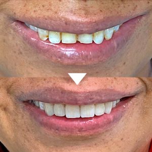 Venners Treatment before and after, thenorthmaindental.com