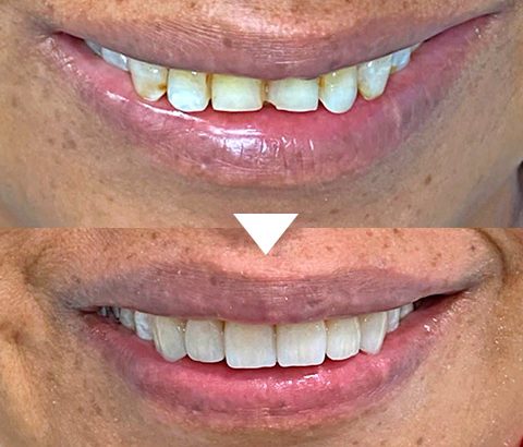Venners Treatment before and after, thenorthmaindental.com