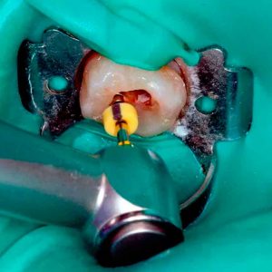 root canal treatment at thenorthmaindental.com