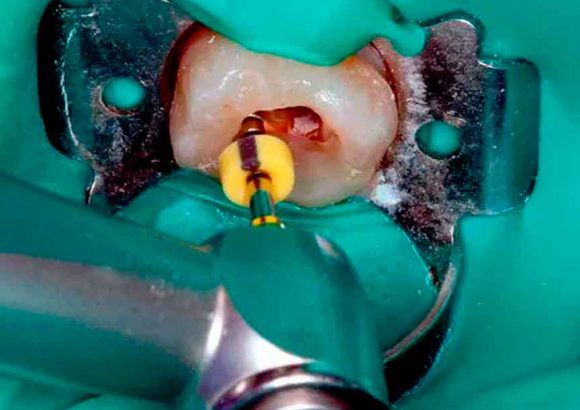 root canal treatment at thenorthmaindental.com