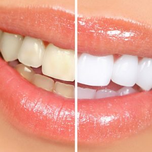 whitening tretament at thenorthmaindental.com