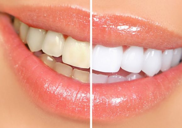 whitening tretament at thenorthmaindental.com